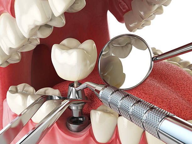 Best Chipped Tooth Repair Near Me  in Ballinger, TX